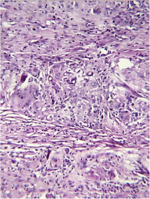 Exame histopatológico da peça cirúrgica. Reação inflamatória granulomatosa com grande número de células gigantes contendo elementos fúngicos arredondados (Hematoxilina & eosina, 200×).