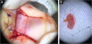 Cirurgia ungueal. (A) Exposição da matriz ungueal. (B) Tumor ressecado.