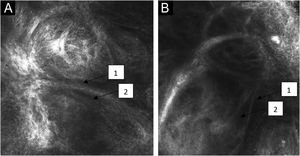 Microscopia confocal de reflectância na derme papilar do carcinoma basocelular com imagens individuais de 0,5 × 0,5 mm2 e mosaico de 8×8 mm2. Ilhas tumorais (*) com fenda peritumoral (1) e silhuetas escuras (2).