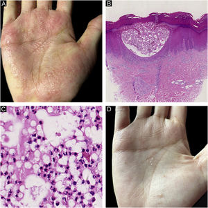 Achados clínicos e histológicos da pustulose palmoplantar (PPP). (A) Múltiplas pústulas e pústulas‐vesículas com eritemas mal circunscritos na palma da mão direita antes do tratamento com secuquinumabe; (B) Coleção de neutrófilos dentro da epiderme espongiforme em visão de menor aumento do PPP (Hematoxilina & eosina, 20×); (C) Coleção de neutrófilos em maior aumento de PPP (Hematoxilina & eosina, 200×); (D) Pústulas dispersas com descamação focal após tratamento com secuquinumabe.