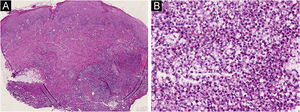 (A) Biópsia de pele obtida da borda da úlcera mostrou células inflamatórias difusas infiltradas em toda a derme. (Hematoxilina & eosina, 20×); (B) Os neutrófilos representaram as células infiltrantes predominantes. (Hematoxilina e eosina, 200×).