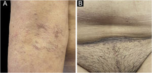 Pápulas hiperpigmentadas acinzentadas e descamação na prega cubital (A) e região abdominal inferior (B).