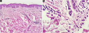 Células inflamatórias ao redor dos vasos dérmicos superficiais que incluíam neutrófilos (A, Hematoxilina & eosina, 100×) também observadas no espaço intersticial entre as fibras de colágeno (B, Hematoxilina & eosina, 400×).