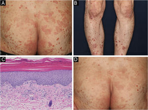 (A) Aspecto clínico do paciente. Lesões psoriasiformes na região glútea. (B) Lesões semelhantes na parte inferior das pernas. (C) Histopatologia com leve paraceratose e epiderme retificada. Infiltração de células inflamatórias perivasculares na derme superficial, acompanhada de extravasamento de hemácias. As células inflamatórias eram eosinófilos, bem como linfócitos e histiócitos (Hematoxilina & eosina, 200×). (D) Resposta parcial ao tratamento.