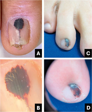 Hematoma. (A) Aspecto clínico: formato oval, aparência enegrecida. (B) Onicoscopia: tonalidade arroxeada, glóbulos e estrias distais. (C) Aspecto clínico: aparecimento de estria longitudinal escurecida. (D) Onicoscopia: tonalidade arroxeada a azulada, bordas sinuosas, glóbulos distais, pigmentação na transparência da cutícula simulando pseudo‐sinal de Hutchinson e leuconiquia no local do trauma.