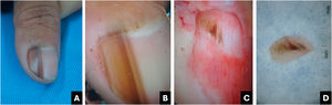 Melanoma. (A) Aspecto clínico: melanoníquia longitudinal marrom clara a escurecida. (B) Onicoscopia: estrias marrom‐claras a escuras com aparente paralelismo, pigmento estendendo‐se além da cutícula. (C) Onicoscopia intraoperatória: linhas irregulares com pigmento marrom claro, área central amorfa marrom escura e algumas manchas marrons e escurecidas assimétricas. (D) Onicoscopia ex vivo: exibe os mesmos achados observados in vivo.