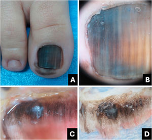 Melanoma. (A) Aspecto clínico: melanoníquia total marrom enegrecida com sinal de Hutchinson (hiponíquio). (B) Onicoscopia: estrias marrom‐escuras a escurecidas, algumas incompletas e não paralelas, com fundo marrom‐acinzentado. (C) Onicoscopia intraoperatória: linhas irregulares enegrecidas, com distribuição assimétrica e área central amorfa branco‐acinzentada a enegrecida. (D) Onicoscopia ex vivo: exibe os mesmos achados observados in vivo.