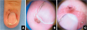 Doença de Bowen. (A) Aspecto clínico: placa eritematosa com pigmento marrom na prega proximal, hiperceratose subungueal lateral associada a onicólise distal e melanoníquia estriada. (B) Onicoscopia da borda livre: hiperceratose subungueal localizada associada a onicólise e estria pigmentar marrom‐acinzentada oblíqua. (C) Onicoscopia (prega proximal): pontos lineares marrons associados a vasos pontilhados.