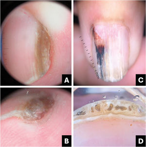 Onicomatricoma. (A) Onicoscopia (superfície da lâmina ungueal): faixa longitudinal acastanhada homogênea. (B) Onicoscopia (borda livre): espessamento da lâmina ungueal. (C) Onicoscopia (superfície da lâmina ungueal): estrias longitudinais brancas, vasos proximais dilatados, pigmento irregular vermelho a escurecido. (D) Borda livre: espessamento da placa com furos.