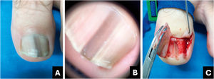 Matricoma onicocítico. (A) Aspecto clínico: faixa longitudinal homogênea cinza‐escurecida. (B) Onicoscopia: faixa longitudinal homogênea acinzentada enegrecida com hiperceratose subungueal. (C) Intraoperatório: tumor linear espesso e pigmentado desde a matriz até o hiponíquio.