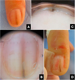 Onicopapiloma. (A) Aspecto clínico: eritro/melanoníquia longitudinal. (B) Onicoscopia (superfície da lâmina ungueal): eritro/melanoníquia pontiaguda na lúnula. (C) Onicoscopia (borda livre): hiperceratose subungueal localizada. (D) Intraoperatório: tumor filiforme pigmentado desde a matriz distal até o hiponíquio.