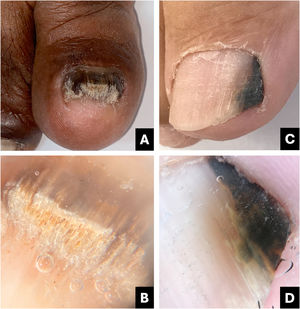 Onicomicose. (A) Aspecto clínico: unha espessada e enegrecida. (B) Onicoscopia: hiperceratose subungueal com aspecto de muro em ruínas, estrias distais largas, branco‐amareladas. (C) Aspecto clínico: faixa irregular e escurecida, mais larga na porção distal (sinal do triângulo invertido). (D) Onicoscopia: estria longitudinal preta irregular, com estrias distais largas branco‐amareladas.