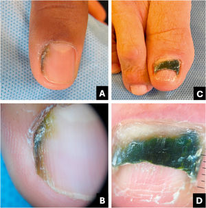 Onicobacteriose. (A) Aspecto clínico: estria preto‐acastanhada irregular. (B) Onicoscopia: tonalidade esverdeada‐acastanhada‐amarelada. (C) Aspecto clínico: onicólise esverdeada escura. (D) Onicoscopia: coloração amarelo‐esverdeada escura.