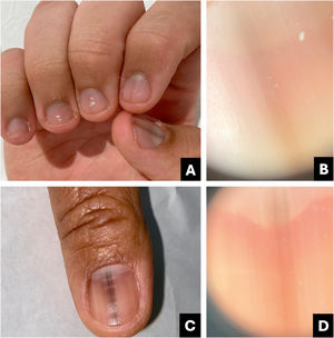 Ativação melanocítica. (A) Aspecto clínico: múltiplas unhas com estrias cinzentas a enegrecidas. (B) Onicoscopia: faixa cinza homogênea mais clara que a visível a olho nu. (C) Aspecto clínico: faixa cinza a escurecida. (D) Onicoscopia: faixa cinza homogênea mais clara que a visível a olho nu.