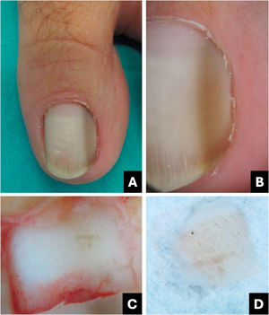 Ativação melanocítica. (A) Aspecto clínico: faixa longitudinal cinza‐acastanhada. (B) Onicoscopia: padrão cinza‐acastanhado homogêneo. (C) Onicoscopia intraoperatória: pigmento cinza‐acastanhado com linhas regulares e alguns pontos. (D) Onicoscopia ex vivo: exibe os mesmos achados observados in vivo.