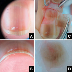 Nevo melanocítico. (A) Onicoscopia da superfície da lâmina ungueal: estrias longitudinais marrom‐claras, escuras e cinzas, contínuas individualmente e paralelas entre si. (B) Onicoscopia da borda livre: pigmento em toda espessura da lâmina ungueal. (C) Onicoscopia intraoperatória: linhas regulares com pigmento marrom claro e algumas áreas de espessamento ou manchas. (D) Onicoscopia ex vivo: exibe os mesmos achados observados in vivo.