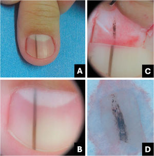 Nevo melanocítico. (A) Aspecto clínico: faixa longitudinal escurecida. (B) Onicoscopia: linhas marrom‐escuras regulares com pequenos grânulos. (C) Onicoscopia intraoperatória: linhas com pigmento marrom escuro e alguns glóbulos ou manchas. (D) Onicoscopia ex vivo: exibe os mesmos achados observados in vivo.