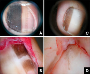 Lentigo simples. (A) Onicoscopia: faixa escurecida homogênea com linhas marrons regulares. (B) Onicoscopia intraoperatória: linhas marrons homogêneas sem manchas. (C) Onicoscopia: faixa homogênea, marrom‐escurecida. (D) Onicoscopia intraoperatória: linhas homogêneas marrom‐acinzentadas sem manchas (Cortesia do Dr. Sérgio Hirata).