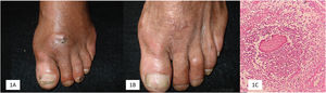 (A) Paciente 1: micetoma por Fusarium chlamydosporum, antes do tratamento. (B) Ao final do tratamento de 18 meses. (C) Microabscesso com grânulo na histopatologia (Hematoxilina & eosina, 10×).