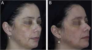 Melasma facial tratado com fotoproteção e N‐acetilcisteína oral, por oito semanas. (A) Antes do tratamento. (B) Após o tratamento.