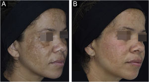 Melasma facial tratado com fotoproteção e placebo oral, por oito semanas. (A) Antes do tratamento. (B) Após o tratamento.