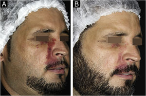 Paciente com clareamento> 75% antes (A) e após (B) a realização de nove sessões de laser Nd:YAG 1064nm de pulso longo associado à luz intensa pulsada.