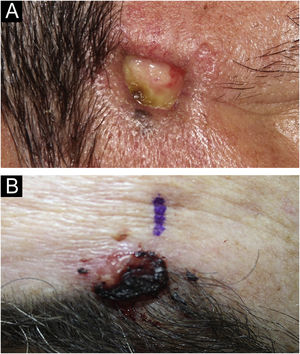 Clínica. (A) Placa normocrômica, de cerca de 2cm, com vasos irregulares na borda e centro ulcerado. (B) Nódulo eritematoso, de cerca de 2cm, com superfície friável recoberta por crosta hemática.