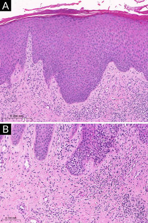 Exame histopatológico da dermatite atópica (lesão subaguda). (A) Epiderme com acantose irregular, hiperceratose e áreas com paraceratose, associada à espongiose discreta (Hematoxilina & eosina, 200×). (B) Infiltrado inflamatório linfocitário da derme superficial, predominantemente perivascular, com esparsos eosinófilos (Hematoxilina & eosina, 400×).