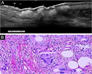 (A) Ultrassonografia mostrando áreas hiperecoicas de nódulos grosseiros. (B) Histopatologia com processo inflamatório granulomatoso, com células gigantes na derme, vesículas redondas vazias de tamanhos variados, fagocitadas por células gigantes e sem evidência de necrose (Hematoxilina & eosina, 400×).