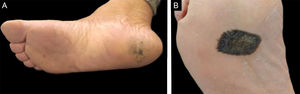 (A) Melanoma acral mal delimitado. (B) Melanoma acral bem delimitado.