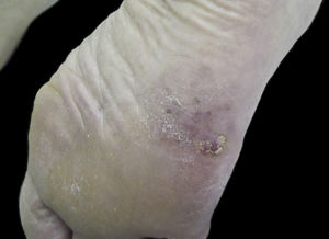 Melanoma acral plantar hipomelanótico.