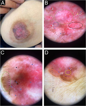 (A) Placa eritêmato‐acastanhada na aréola esquerda medindo 3×3cm, com bordas irregulares e mamilo achatado. (B) Seta vermelha: escama; seta azul: fibras de tecido aderentes; seta amarela: erosões superficiais; anel verde: estrias brancas brilhantes; anel azul: vaso pontilhado irregular; anel preto: área branca rosada sem estrutura. Dermlite DL4– ampliação 10×– modo luz polarizada. (C) Seta azul: fibras de tecido aderentes; seta preta: erosões superficiais; seta laranja: escama; anel verde: linhas radiais marrons segmentares e pontos marrom‐acinzentados. Dermlite DL4– ampliação 10×– modo luz polarizada. (D) Seta azul: escama; seta verde: fibras de tecido aderentes; anel amarelo: vasos pontilhados; anel laranja: linhas radiais segmentares e pontos marrom‐acinzentados. Dermlite DL4– ampliação 10×– modo luz polarizada.