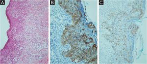 (A) Células epiteliais malignas dispersas como células isoladas ou agrupadas na epiderme (Hematoxilina & eosina, 200×). (B) Imunomarcação na membrana das células epiteliais malignas na epiderme com C‐ERB‐B2 (200×). (C) Imunomarcação citoplasmática nas células epiteliais malignas com CK7 (200×).