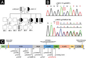 Genograma e sequenciamento de GPNMB e estrutura proteica. (A) Linhagem do probando. Os asteriscos representam os participantes com testes genéticos. (B) O sequenciamento de Sanger do probando mostrou mutações heterozigóticas compostas de c.565C>T no éxon 5 e c.1092delT no éxon 7 de GPNMB. (C) Estrutura e 16 mutações da proteína GPNMB humana originadas de 17 GPNMB mutantes (p.V240Dfs*24 derivados dos mutantes c.717_718delTG e c.719_720delTG). Uma nova mutação c.1092delT nessa linhagem está marcada em vermelho. Mutantes GPNMB‐1 (uma isoforma de splice de GPNMB) com inserção in frame de 12 aminoácidos (sublinhada) e motivos tipo RGD e Di‐leucina também são mostrados. SIG, domínio de sequência de sinais; NTD, domínio N‐terminal; PKD, domínio de doença renal policística‐símile; KRG, domínio Kringle‐ símile; TM, domínio transmembrana; CTD, domínio citoplasmático C‐terminal.