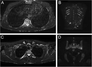 Paciente 1: Imagens de ressonância magnética de inversão‐recuperação com tau curto (STIR do inglês Short Tau Inversion Recovery; esquerda) do tórax revelando sinais de hiperintensidade nodular na região cutâneo‐subcutânea afetando a parede torácica anterior, bem como a região dorsal (A); sinal de hiperintensidade do arco posterior da quarta costela à direita devido a edema da medula, mas sem edema dos tecidos moles circundantes (B). Imagens de corpo inteiro ponderadas em difusão coronal com supressão do sinal de fundo (DWIBS, do inglês Diffusion‐Weighted Whole‐Body Imaging with Background Body Signal Suppression; direita) demonstrando aumento do sinal em múltiplas alterações subcutâneas na região dorsal do paciente (C); sinal de hiperintensidade focal na articulação sacro‐ilíaca esquerda (D).