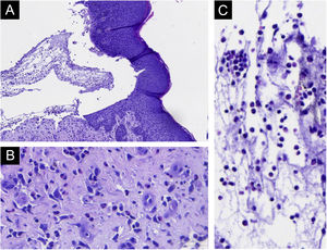 (A) Bolha subepidérmica, sem necrose epitelial. (B) Eosinófilos na derme (setas). (C) Eosinófilos dentro da bolha (setas).