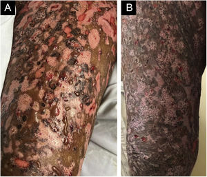 (A) Áreas hipocrômicas reepitelizadas, erosões decorrentes da primeira piora e bolhas novas. (B) Reepitelização quase completa das lesões.