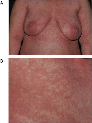 Exantema maculopapular na DRESS. (A) Acometimento extenso do tronco. (B) Detalhe das lesões: pápulas eritematosas que confluem em placas.