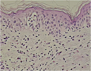 DRESS (Hematoxilina & eosina, 400×). Dermatite vacuolar de interface, leve espongiose, exocitose de linfócitos. Na derme, há infiltrado linfocitário difuso com frequentes eosinófilos.