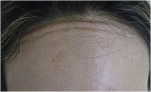 Contração de fibras musculares occipito‐frontal após tratamento da porção glabra da região frontal. Provável prolongamento do músculo frontal superior com diminuição relativa da aponeurose epicrânica.