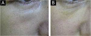 (A‐B) Nódulo não inflamatório infraorbital após 60 dias do preenchimento com ácido hialurônico. (B) Quatro dias após tratamento com hialuronidase. Nota: Não referia a marca do produto nem a quantidade.