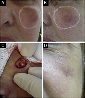 Nódulo inflamatório. Drenado com presença de secreção seropurulenta. (A‐B) Região malar esquerda. Nódulo palpável em todo o perímetro circundado em branco. Eritema, edema, aumento da temperatura local e dor à palpação. Vinte dias depois, iniciou preenchimento com ácido hialurônico, supraperiostal, segundo informação da profissional que realizou o procedimento. (C‐D) Drenagem e limpeza da cavidade. Material purulento, espesso e sem odor. Cicatriz com perda de volume na região drenada. Efeito adverso permanente (grave).