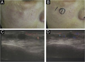 (A‐D) Reativação inflamatória em locais tratados com biomaterial após infecção à distância; no caso, amigdalite. (C‐D) Aspecto ultrassonográfico: aumento da vascularização ao redor do biomaterial.