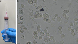 Exame de pesquisa direta de secreção coletada por punção guiada por ultrassom (A) evidenciando o parasita Entamoeba histolytica na forma de cistos e, ao centro da imagem (B), de trofozoíta.