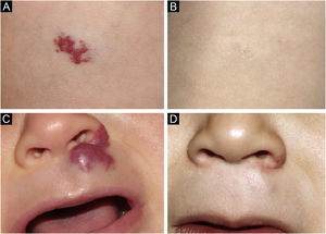 Caso 5. Hemangioma infantil superficial na linha média axilar direita. (A) Antes do tratamento. (B) Resposta completa após o tratamento. Hemangioma infantil misto no nariz. (C) Antes do tratamento. (D) Resposta completa após o tratamento.