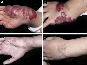 Caso 8. Hemangioma infantil misto no punho esquerdo. (A) Região palmar. Antes do tratamento. (B) Região dorsal da mão. Antes do tratamento. (C) Região palmar. Resposta completa após o tratamento. (D) Dorso da mão. Resposta completa após o tratamento.