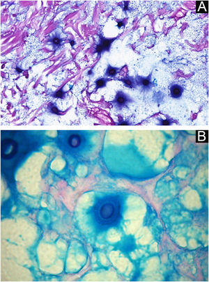 Criptococose cutânea primária. (A) Coloração pelo alcian‐blue com marcação do Cryptococcus em azul incluindo a cápsula mucoide. (B) Detalhe em grande aumento.