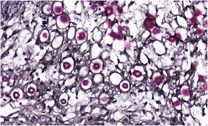 Criptococose cutânea primária. Coloração pelo mucicarmin com marcação do Cryptococcus na cor vermelho escuro incluindo parte da cápsula mucoide.