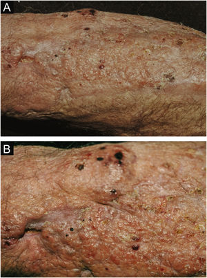 Criptococose cutânea primária. (A) Lesão em placa, extensa, com pontos necróticos, ulcerados, aspecto de pseudovesícula, presença de escamo‐crostas. Paciente do sexo masculino, 70 anos. Corticoterapia 5mg/dia, irregular, artrite. Residente na zona rural. (B) Detalhe: presença de lesão de aspecto tumoral e pontos necróticos e lesões satélites com aspecto de pseudovesículas.