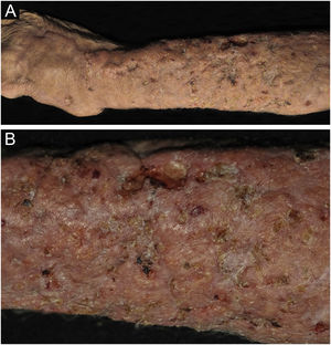 Criptococose cutânea primária. (A) Lesão infiltrada, extensa, nodulações, ulcerações, pontos necróticos, região distal do braço, antebraço e dorso da mão. Paciente do sexo masculino, 77 anos. Corticoterapia, 10mg/dia, DPOC. Residente na zona rural. (B) Detalhe: nodulações, retrações cicatriciais, pontos de ulceração e necrose.